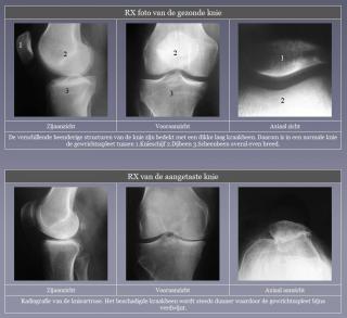 Slijtage artrose knie radiografie