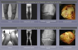 Wear arthritis knee
