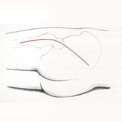 Hip surgery: posterior or back access