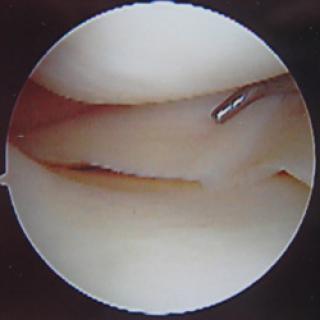 Gezonde meniscus